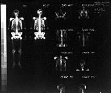 Most cancers Os Rachis