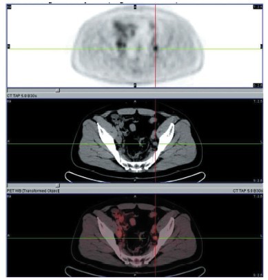 Most cancers Rayon Prostate