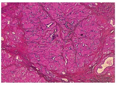 Traitement cancer Vesicule Seminale