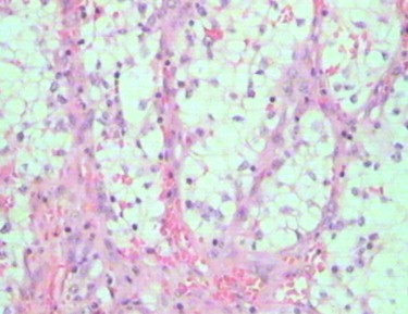 Carcinome Rénal Métastatique